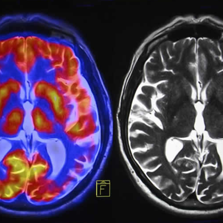 Kako KRONIČNI STRES spremeni možgane?
